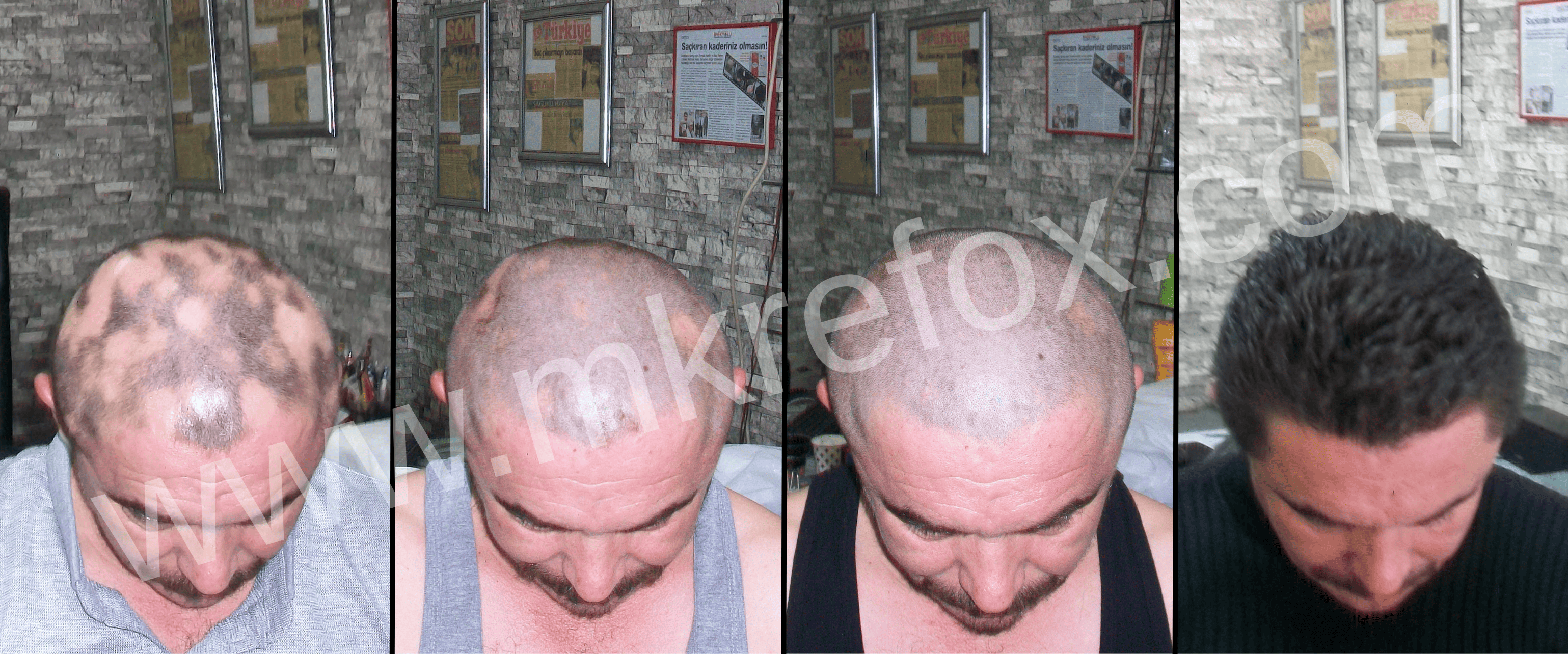Konya Alopesi Areata (Saçkıran) Tedavisi