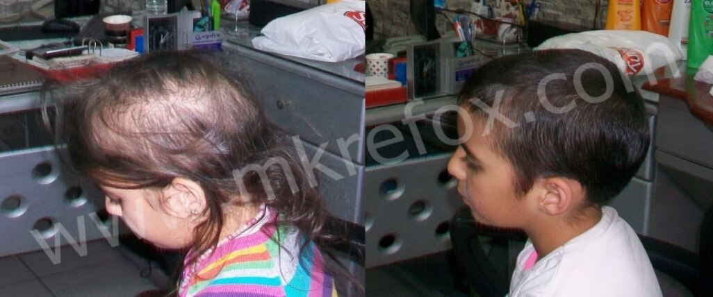 Alopesi Areata Tedavisinde Başarı