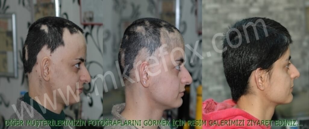 Alopesi Areata Tedavi Merkezi Konya