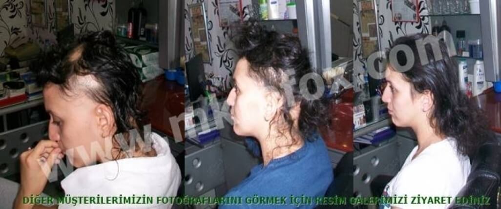 Alopesi Areata Tedavi Fiyatları