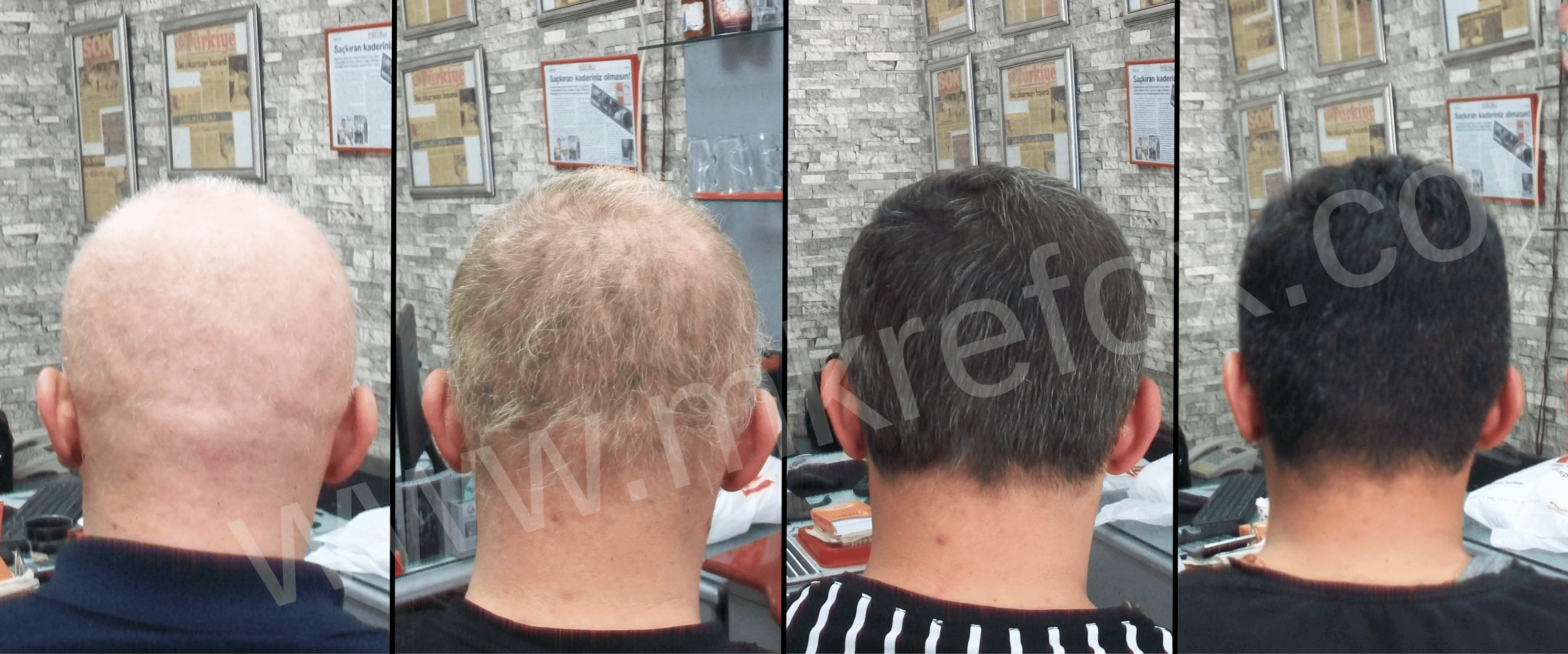 Alopesi Tedavisinde Başarı Hikayeleri